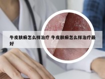 牛皮肤癣怎么样治疗 牛皮肤癣怎么样治疗最好