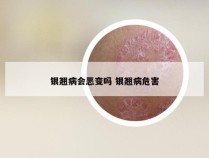 银翘病会恶变吗 银翘病危害