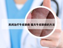 民间治疗牛皮肤癣 偏方牛皮肤癣的方法