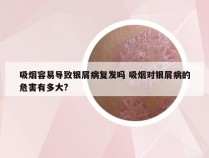 吸烟容易导致银屑病复发吗 吸烟对银屑病的危害有多大?