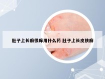 肚子上长癣很痒用什么药 肚子上长皮肤癣