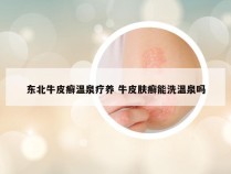 东北牛皮癣温泉疗养 牛皮肤癣能洗温泉吗