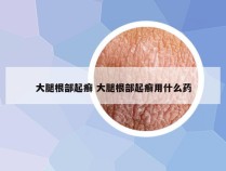 大腿根部起癣 大腿根部起癣用什么药