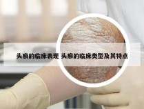 头癣的临床表现 头癣的临床类型及其特点