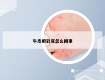 牛皮癣到底怎么回事