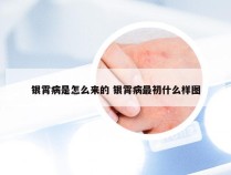 银霄病是怎么来的 银霄病最初什么样图