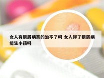 女人有银屑病真的治不了吗 女人得了银屑病能生小孩吗