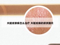 大腿皮肤癣怎么治疗 大腿皮癣的症状图片