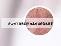 身上长了点状的藓 身上点状癣怎么回事