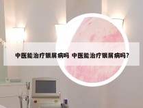 中医能治疗银屑病吗 中医能治疗银屑病吗?