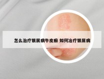 怎么治疗银屑病牛皮癣 如何冶疗银屑病