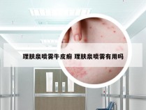 理肤泉喷雾牛皮癣 理肤泉喷雾有用吗