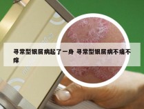 寻常型银屑病起了一身 寻常型银屑病不痛不痒