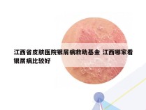 江西省皮肤医院银屑病救助基金 江西哪家看银屑病比较好