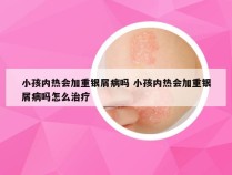 小孩内热会加重银屑病吗 小孩内热会加重银屑病吗怎么治疗