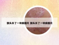 额头长了一块癣图片 额头长了一块癣图片