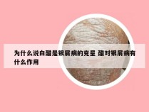 为什么说白醋是银屑病的克星 醋对银屑病有什么作用