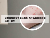 又有银屑病又有痛风怎办 为什么银屑病和痛风会一起犯