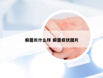 癣菌长什么样 癣菌症状图片