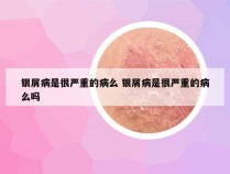 银屑病是很严重的病么 银屑病是很严重的病么吗