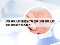 炉甘石氧化锌洗剂治疗牛皮癣 炉甘石氧化锌洗剂涂抹完之后怎么办