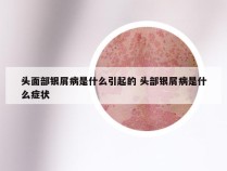 头面部银屑病是什么引起的 头部银屑病是什么症状