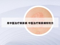 用中医治疗银屑病 中医治疗银屑病特效方