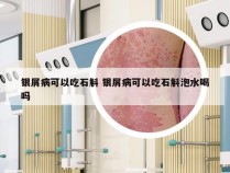 银屑病可以吃石斛 银屑病可以吃石斛泡水喝吗