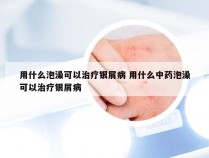 用什么泡澡可以治疗银屑病 用什么中药泡澡可以治疗银屑病