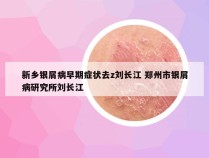 新乡银屑病早期症状去z刘长江 郑州市银屑病研究所刘长江