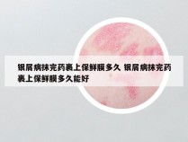 银屑病抹完药裹上保鲜膜多久 银屑病抹完药裹上保鲜膜多久能好