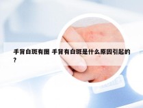 手背白斑有图 手背有白斑是什么原因引起的?