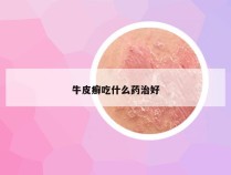 牛皮癣吃什么药治好