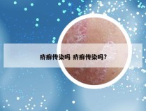 疥癣传染吗 疥癣传染吗?