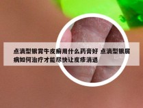 点滴型银霄牛皮癣用什么药膏好 点滴型银屑病如何治疗才能尽快让皮疹消退