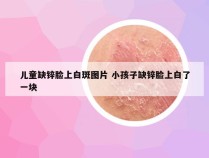 儿童缺锌脸上白斑图片 小孩子缺锌脸上白了一块