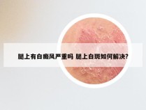 腿上有白癜风严重吗 腿上白斑如何解决?