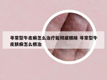 寻常型牛皮癣怎么治疗能彻底根除 寻常型牛皮肤癣怎么根治