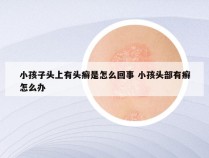 小孩子头上有头癣是怎么回事 小孩头部有癣怎么办