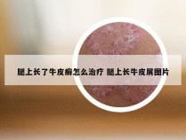 腿上长了牛皮癣怎么治疗 腿上长牛皮屑图片