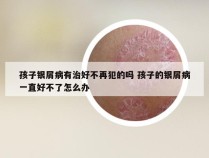 孩子银屑病有治好不再犯的吗 孩子的银屑病一直好不了怎么办