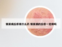 银屑病丘疹用什么药 银屑病的丘疹一定痒吗