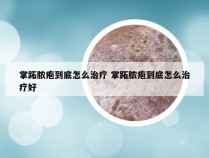 掌跖脓疱到底怎么治疗 掌跖脓疱到底怎么治疗好