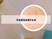 牛皮癣洗浴用什么药