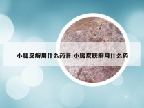 小腿皮癣用什么药膏 小腿皮肤癣用什么药