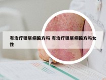 有治疗银屑病偏方吗 有治疗银屑病偏方吗女性