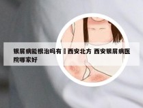 银屑病能根治吗有約西安北方 西安银屑病医院哪家好