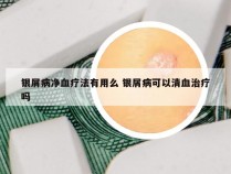 银屑病净血疗法有用么 银屑病可以清血治疗吗