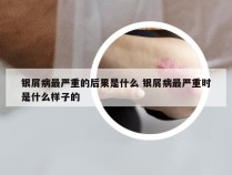 银屑病最严重的后果是什么 银屑病最严重时是什么样子的