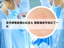 关节疼银屑病小红点儿 银屑病关节处红了一片